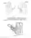 Fig. 05 - Finger trigger splint for joint immobilization and flexion inhibition
