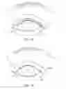 Fig. 12 - Dry eye treatment systems