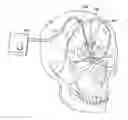 Fig. 01 - Solid conduction induced hypothermia devices
