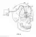 Fig. 04 - Solid conduction induced hypothermia devices