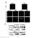Fig. 06 - Method for treating a refractory or relapsed lung cancer