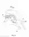 Fig. 04 - AIRWAY DEVICE