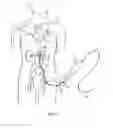 Fig. 02 - System and method for traversing an arterial occlusion