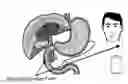 Fig. 01 - Biliary tract drainage tube