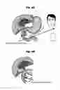 Fig. 05 - Biliary tract drainage tube