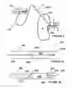 Fig. 04 - Methods and apparatus for bilateral renal neuromodulation