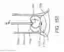 Fig. 23 - ENGAGEMENT AND DELIVERY CATHETER SYSTEMS