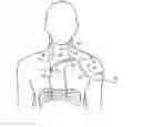 Fig. 01 - Apparatus and methods for assisted breathing by transvascular nerve stimulation