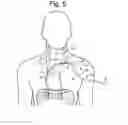 Fig. 06 - Apparatus and methods for assisted breathing by transvascular nerve stimulation