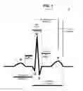 Fig. 02 - System and method for stimulating the heart in combination with cardiac rhythm management pharmaceuticals