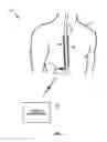 Fig. 02 - Electrical stimulation therapy for inducing patient sensations