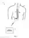 Fig. 02 - Electrical stimulation therapy for inducing patient sensations
