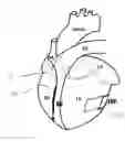 Fig. 01 - Methods and devices for multi-stage ventricular therapy