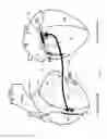 Fig. 03 - Methods and devices for multi-stage ventricular therapy