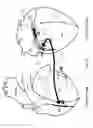 Fig. 04 - Methods and devices for multi-stage ventricular therapy