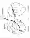 Fig. 05 - Methods and devices for multi-stage ventricular therapy