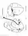 Fig. 07 - Methods and devices for multi-stage ventricular therapy