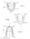 Fig. 17 - INTRA-ORAL LIGHT-THERAPY APPARATUSES AND METHODS FOR THEIR USE