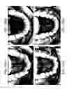 Fig. 92 - INTRA-ORAL LIGHT-THERAPY APPARATUSES AND METHODS FOR THEIR USE