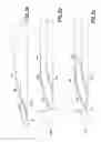 Fig. 04 - Five-bevel cannula for blood acquisition devices