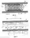 Fig. 03 - HIGH VISIBILITY ENDOPROSTHESIS AND METHOD