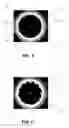 Fig. 04 - HIGH VISIBILITY ENDOPROSTHESIS AND METHOD