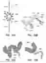 Fig. 11 - CATHETER BALLOON METHODS AND APPARATUS EMPLOYING SENSING ELEMENTS