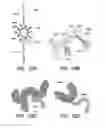 Fig. 11 - CATHETER BALLOON METHODS AND APPARATUS EMPLOYING SENSING ELEMENTS