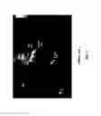 Fig. 03 - METHOD AND SYSTEM FOR ENHANCED VISUALIZATION AND SELECTION OF A REPRESENTATIVE ULTRASOUND IMAGE BY AUTOMATICALLY DETECTING B LINES AND SCORING IMAGES OF AN ULTRASOUND SCAN