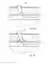 Fig. 07 - Vascular closure device