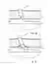 Fig. 07 - Vascular closure device