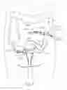 Fig. 07 - Apparatus and method for pleating a bodily lumen