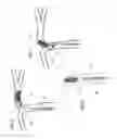 Fig. 06 - Clot engagement and removal system