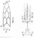 Fig. 69 - Clot retrieval system