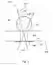 Fig. 04 - Trans-endoscopic and laparoscopic surgery port