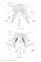 Fig. 02 - Reduced extravasation of bone cement