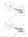 Fig. 07 - Reduced extravasation of bone cement