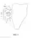 Fig. 04 - ORTHODONTIC LIGATURE