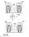 Fig. 14 - Methods of designing and manufacturing customized dental prosthesis for periodontal or osseointegration and related systems