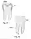 Fig. 21 - Methods of designing and manufacturing customized dental prosthesis for periodontal or osseointegration and related systems