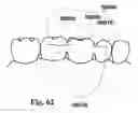 Fig. 41 - Methods of designing and manufacturing customized dental prosthesis for periodontal or osseointegration and related systems