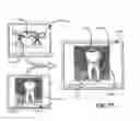 Fig. 56 - Methods of designing and manufacturing customized dental prosthesis for periodontal or osseointegration and related systems