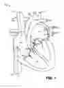 Fig. 02 - Trileaflet mechanical prosthetic heart valve