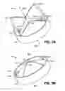 Fig. 04 - Trileaflet mechanical prosthetic heart valve