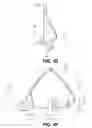 Fig. 07 - Trileaflet mechanical prosthetic heart valve