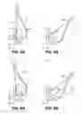 Fig. 09 - Trileaflet mechanical prosthetic heart valve