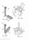 Fig. 15 - Heart valve with integrated stent and sewing ring
