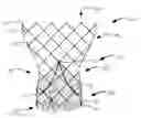 Fig. 01 - Subannular sealing for paravalvular leak protection