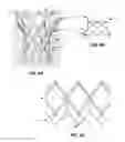 Fig. 11 - Subannular sealing for paravalvular leak protection