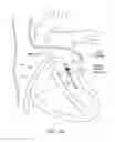 Fig. 13 - Methods for delivery of heart valve devices using intravascular ultrasound imaging